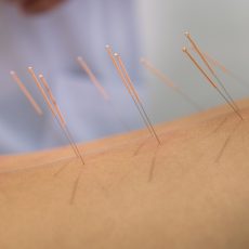 Acupuncture