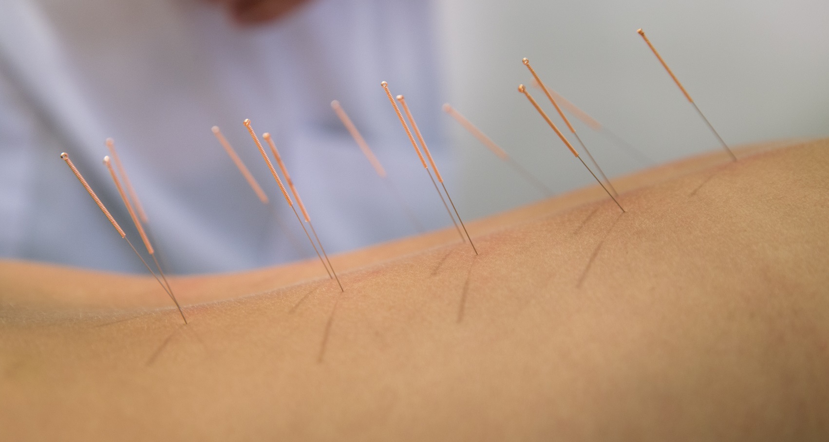 Acupuncture Traditional Chinese Medicine for Fertility IVF Pain Relief